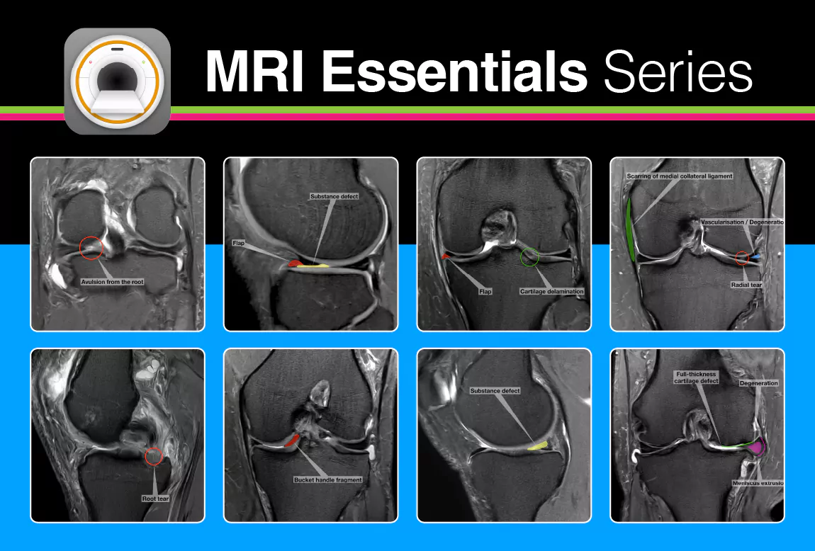 Diagnostic Accuracy of Artificial Intelligence Using MRI for Differentiating Benign and Malignant Musculoskeletal Tumors